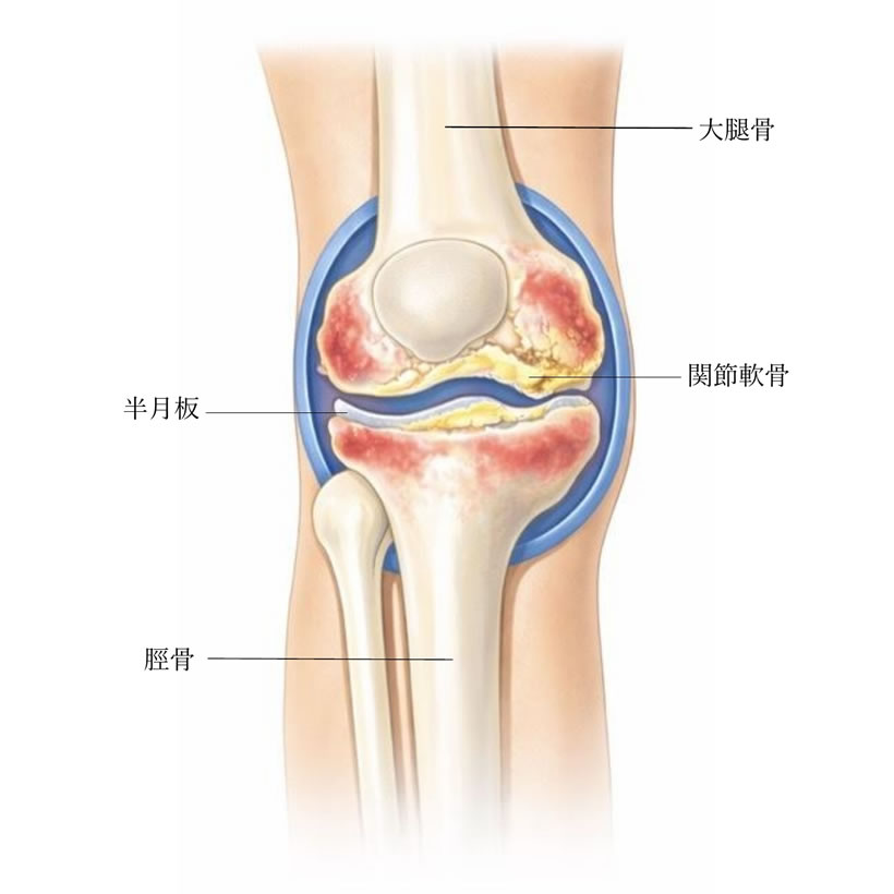 変形性膝関節症