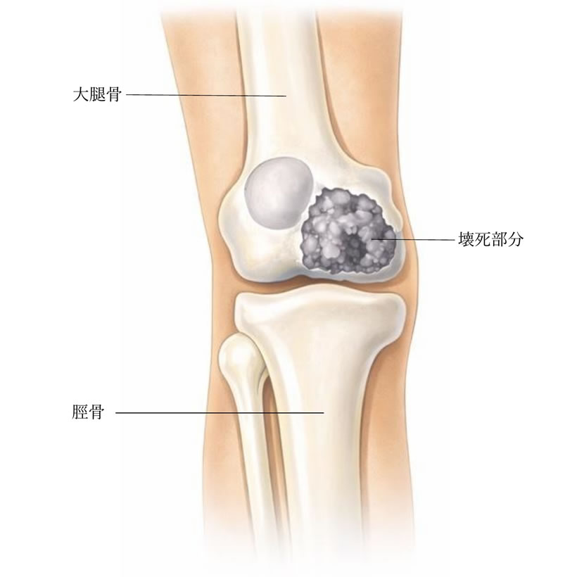 大腿骨頭顆部骨壊死