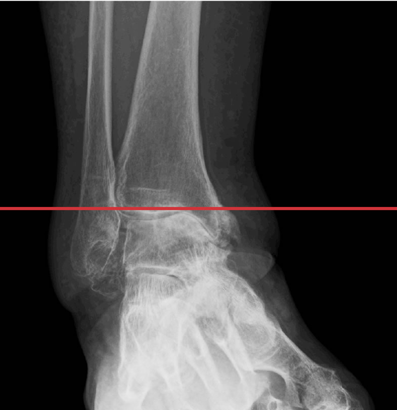 変形性足関節症