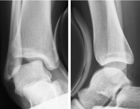 足関節外側靭帯断裂（捻挫）