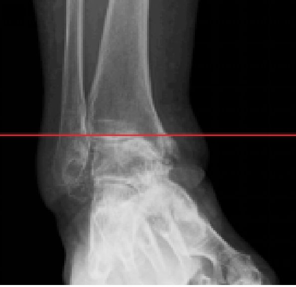 変形性足関節症