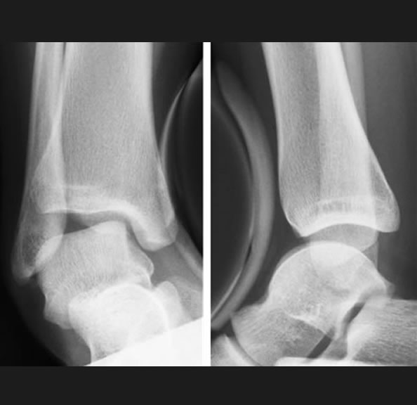 足関節外側靭帯断裂（捻挫）