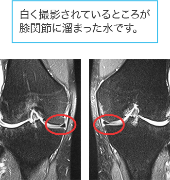 手術前レントゲン画像・膝軟骨内視鏡画像02