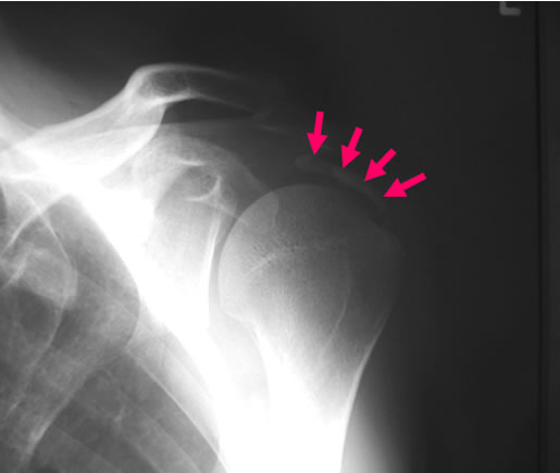 石灰により腱が腫脹しぶつかり挟まる原因