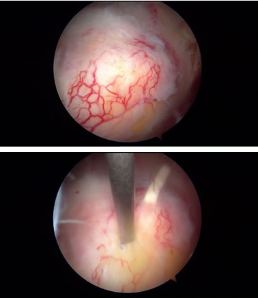 石灰により腱が腫脹しぶつかり挟まる原因
