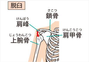 反復性肩関節脱臼