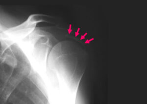 石灰沈着性腱炎