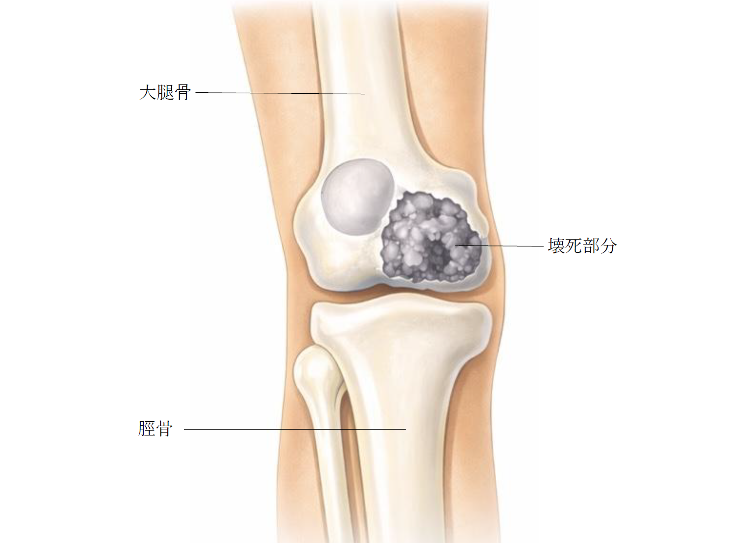 大腿 骨 内 顆 骨 壊死